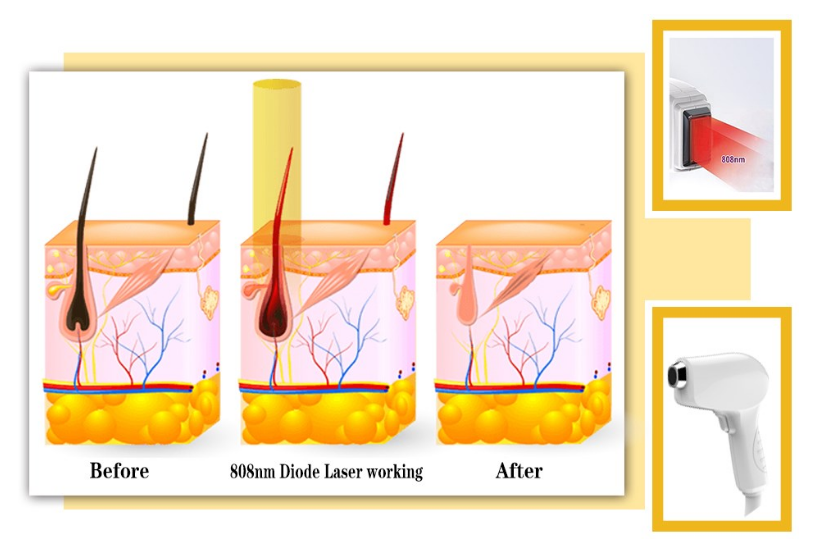 Laser Hair Removal Machine Laser Hair Removal Machine