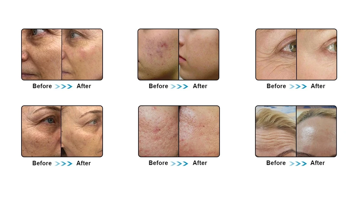 beijing sanhe tech Rf Microneedling Machine beijing sanhe tech Rf Microneedling Machine
